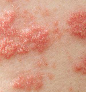 Raised red bumps and blisters caused by the shingles virus